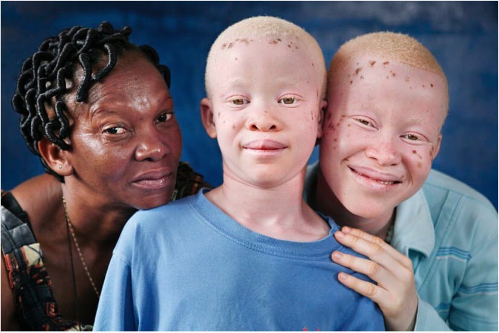 enfant-albinos-5-topafro-1024x684.jpg